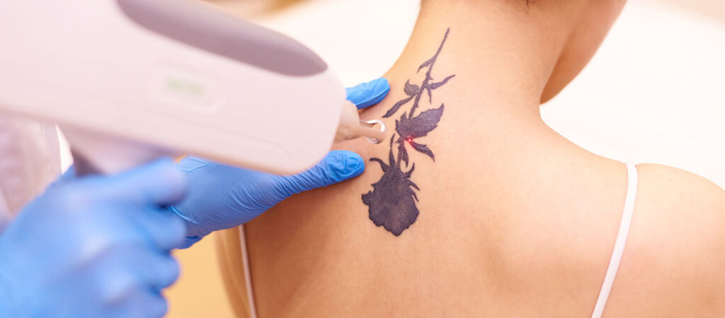 Face & Body Tattoo Removal