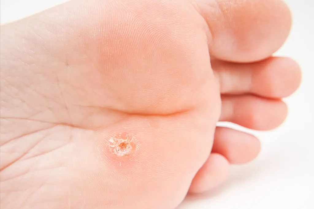 Plantar Warts