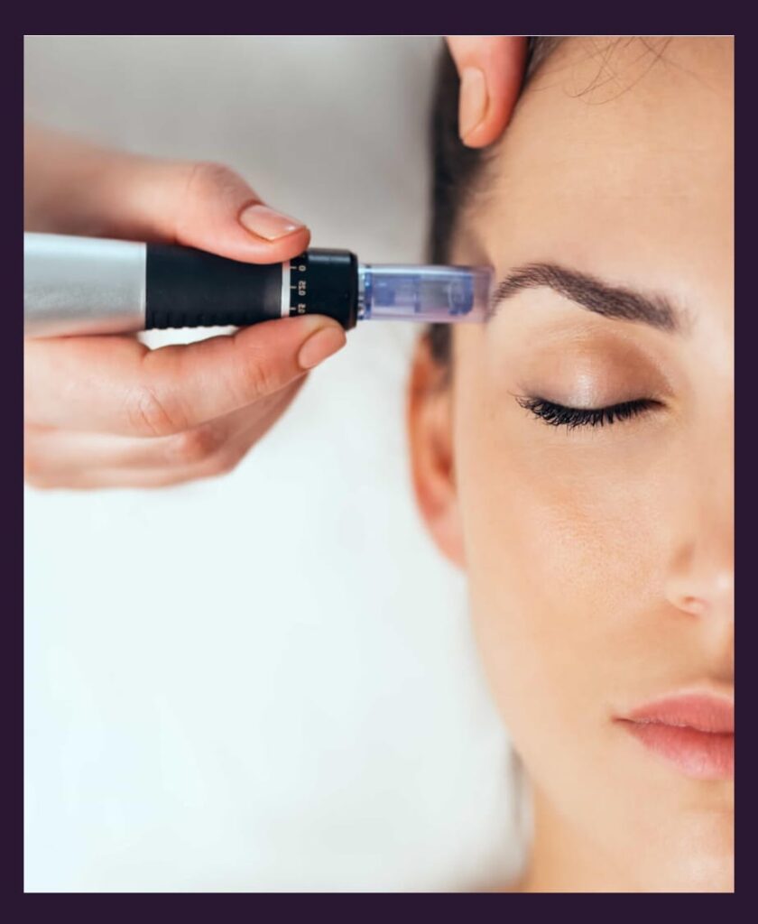 Micro needling