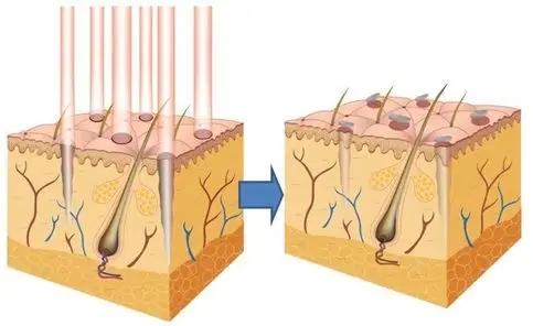 Fractional CO2 laser