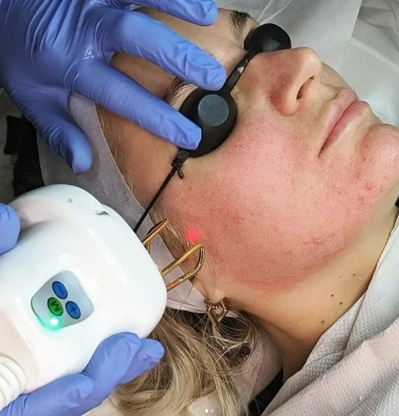 Fractional CO2 laser