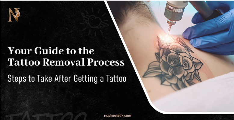 Your Guide to the Tattoo Removal Process: Steps to Take After Getting a Tattoo